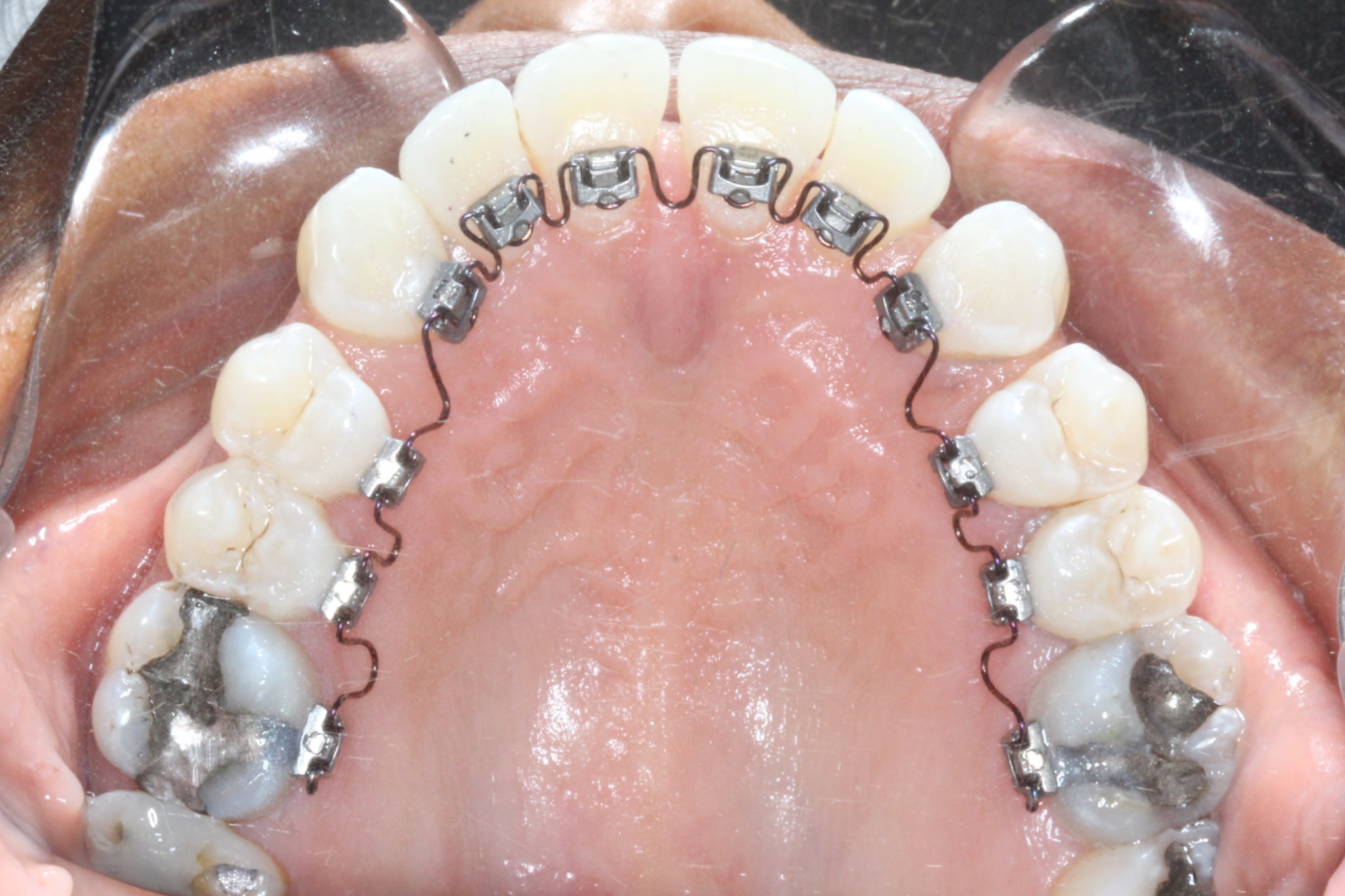 Lingual Braces 